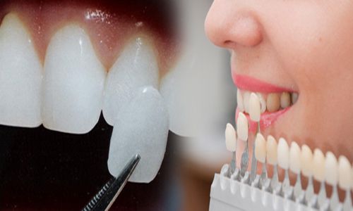 Răng sứ veneer là gì? 3