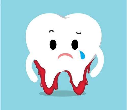 Nhổ răng hàm có nguy hiểm không?  1