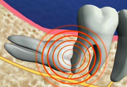 Thực hiện nhổ răng khôn hàm dưới có nguy hiểm không? 2