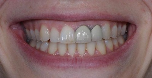 Bọc răng sứ titan có bị đen không? Cách xử lý viền nướu không bị đen-1