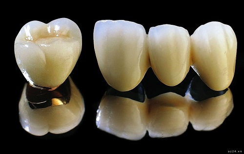 Bọc răng sứ titan có bị đen không? Cách xử lý viền nướu không bị đen-2