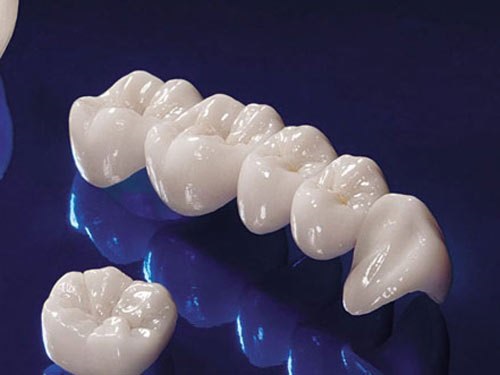 Bọc răng sứ titan có bị đen không? Cách xử lý viền nướu không bị đen-4