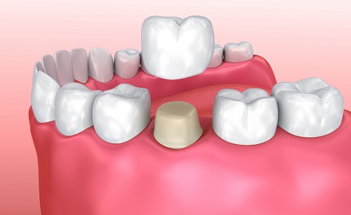 Trồng răng sứ có đau không? Phương pháp trồng răng sứ 1