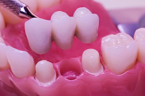 Trồng răng sứ có đau không? Phương pháp trồng răng sứ 2