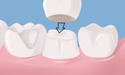 Phương pháp bọc răng sứ không cần mài răng hiệu quả nhất cho bạn-3