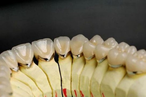 Thông tin về bọc răng sứ kim loại thường 1
