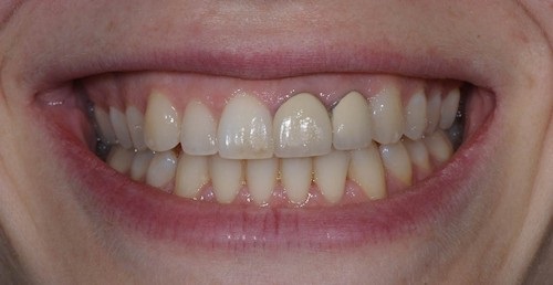 Thông tin về bọc răng sứ kim loại thường 3