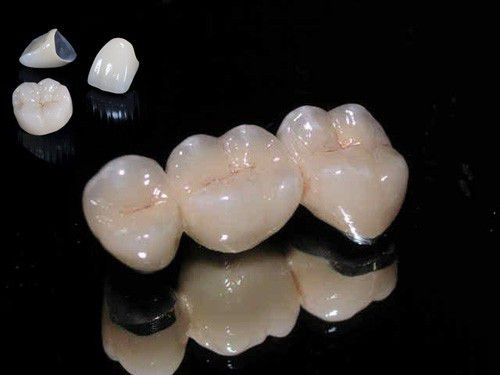 Bọc răng sứ titan có tốt không? 3 ưu điểm để chứng minh-1