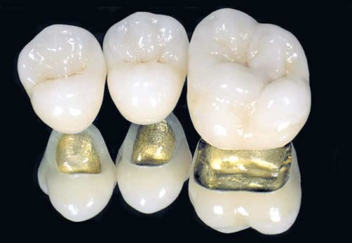 Dịch vụ bọc răng sứ zirconia có những ưu điểm nổi bật gì?-2