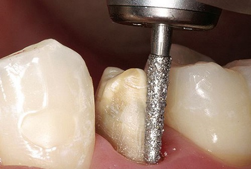 Giá bọc răng sứ zirconia tốt nhất cho bạn-4