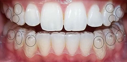 Niềng răng không mắc cài 3d clear aligner thực hiện như thế nào?-1