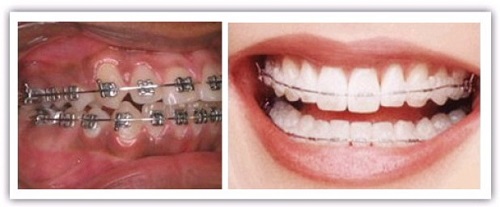Niềng răng móm cho hàm răng đều đặn chuẩn khớp cắn 3