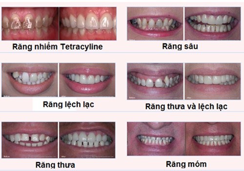 Bọc răng sứ nguyên hàm giá bao nhiêu là chuẩn? 1