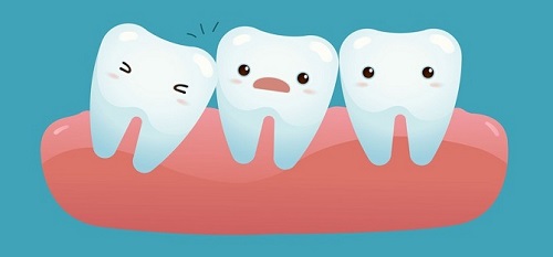 Nhổ răng khôn có tốt không? Trường hợp nào nên nhổ răng khôn 2