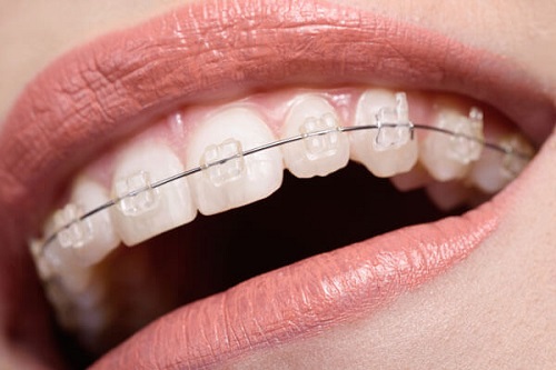 Niềng răng 1 hàm có đau không với mắc cài sứ? 1