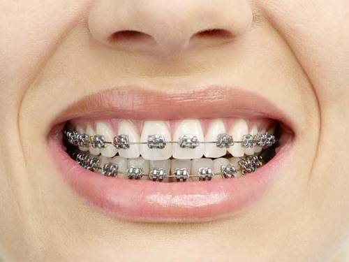 Nhổ răng khôn có tốt không? Trường hợp nào nên nhổ răng khôn-3