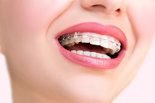 Niềng răng hàm trên mất bao lâu là răng thẳng đều? 1