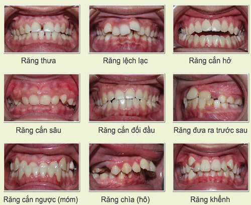 Niềng răng hàm trên mất bao lâu là răng thẳng đều? 2