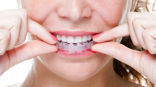 Niềng răng invisalign có tốt không? Ưu điểm niềng răng invisalign là gì?-1