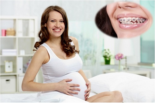 Niềng răng khi mang thai có được không?-1