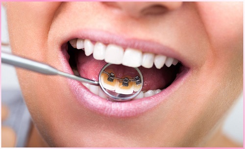Phương pháp niềng răng mắc cài mặt lưỡi với ưu điểm vượt trội-2
