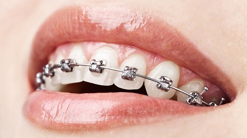 Giải pháp tái tạo khớp cắn - Niềng răng sai khớp cắn-3