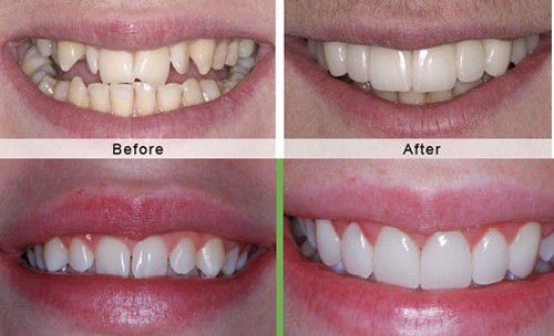 Bọc răng sứ có hết móm không khi bị móm do răng? 2