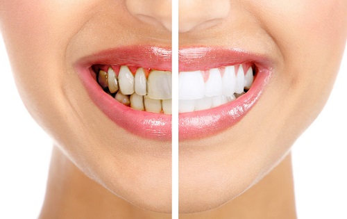 Có nên tẩy trắng răng nhiều lần không? 1
