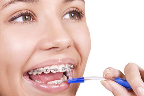 Niềng răng có nguy hiểm không? Những thông tin nên biết trước khi niềng răng-4