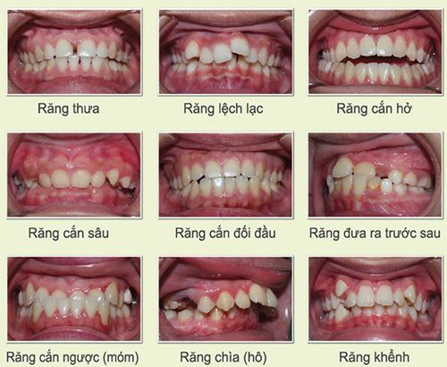 Niềng răng mặt trong có đau không theo quy trình đạt chuẩn? 2