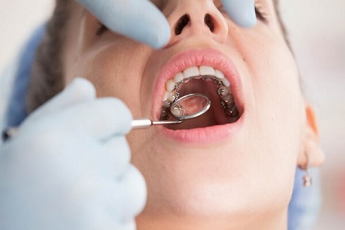 Quá trình thực hiện niềng răng mặt trong mất bao lâu?-2