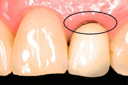 Dấu hiệu răng sứ bị hở nguyên nhân và cách khắc phục-1