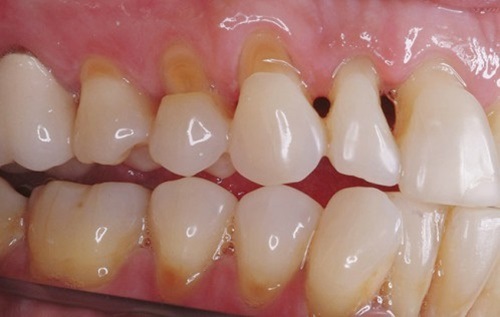 Răng sứ bị mòn mặt nhai - Nguyên nhân và cách khắc phục-2