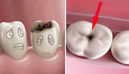 Răng sứ bị sâu có điều trị được không? Phải làm gì? 2