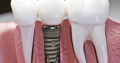 Trồng răng implant có đau không? Tìm hiểu về dịch vụ trồng răng 2