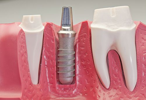 Trồng răng implant có đau không? Tìm hiểu về dịch vụ trồng răng 3