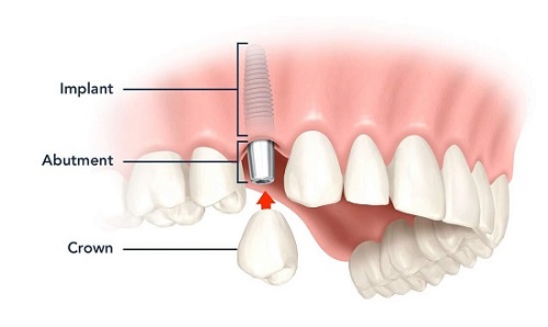 Trồng răng giả có đau không? Tìm hiểu kỹ thuật trồng-3