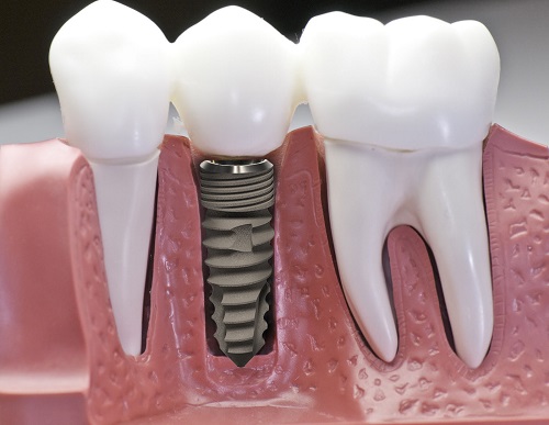 Trồng răng có ảnh hưởng gì không? Tìm hiểu chung 1