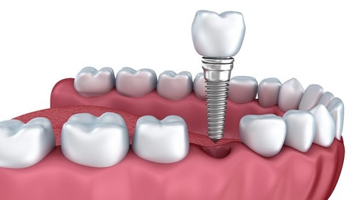 Trồng răng có ảnh hưởng gì không? Tìm hiểu chung 3