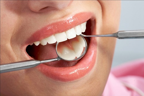 Trám răng hàm trên và những điều bạn cần lưu ý 3