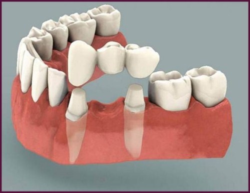 Trồng răng có nhanh không? Phụ thuộc các yếu tố nào? 3