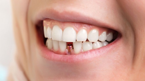 Trồng răng cửa hàm dưới - Tìm hiểu phương pháp trồng răng 2