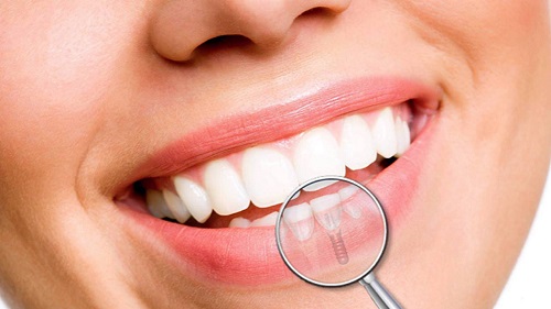 Trồng răng cửa hàm dưới - Tìm hiểu phương pháp trồng răng 4