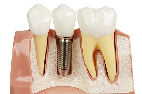Trồng răng giả có lâu không? Phụ thuộc vào yếu tố nào? 3