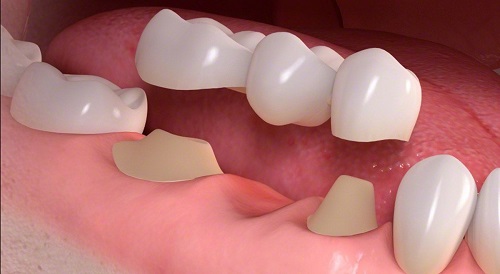 Trồng răng sứ dùng được bao lâu? Tùy thuộc yếu tố nào? 1