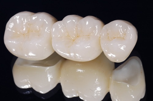 Trồng răng sứ dùng được bao lâu? Tùy thuộc yếu tố nào? 2