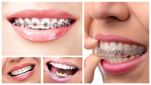 Niềng răng không đều - Phương pháp khắc phục hiệu quả 3