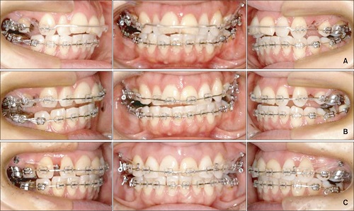 Niềng răng phải nhổ răng nào? Chuyên gia giải đáp 2