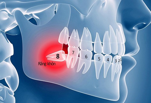 Răng khôn bị nhiễm trùng - Dấu hiệu - Cách khắc phục 1