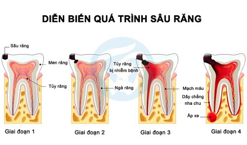 Răng khôn bị sâu chảy máu - Cách điều trị phù hợp 2